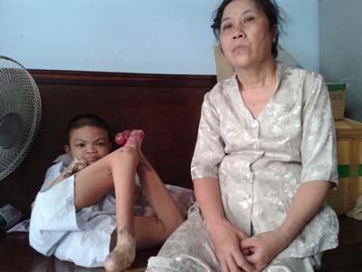 Mắc bệnh lạ, chàng trai 19 tuổi rụng cả tứ chi, nhỏ như thiếu nhi